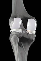 Imagem ilustrando cartilagem articular normal (área branca)