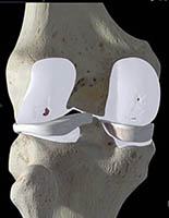 Imagem ilustrando machucado na cartilagem articular