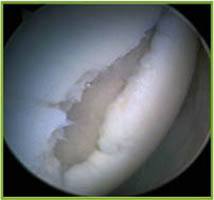 Artroscopia mostrando lesão na cartilagem articular.