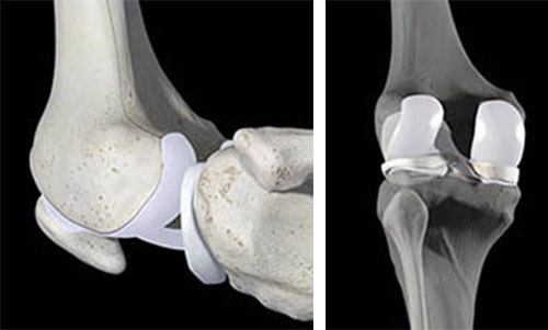 A cartilagem (área branca) reveste o osso e permite que deslizem suavemente entre si.