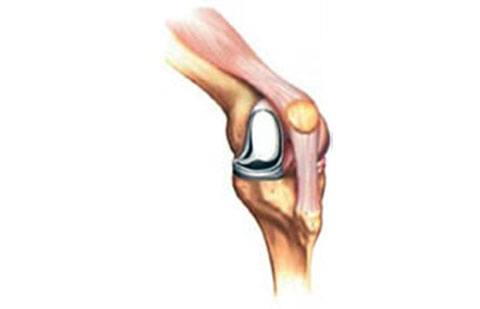 Imagem ilustrando artrose medial do joelho.