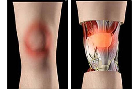 Bursite do joelho numa vista de frente. Note a inflamação sobre a região da patela.