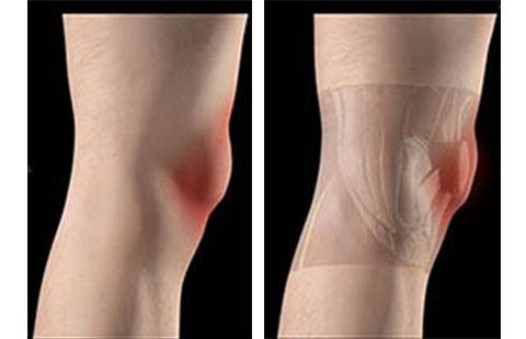 Bursite do joelho numa vista lateral. Note a inflamação sobre a região da patela.