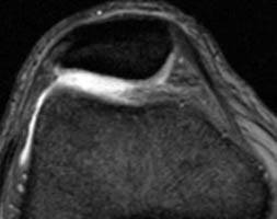 Imagem de Ressonância: Condromalácia de Patela
