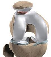 Condromalácia na patela.