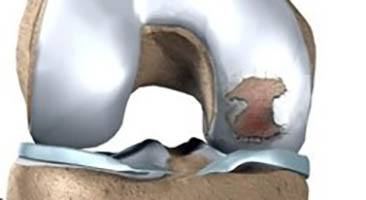 Exemplo de lesão na cartilagem do joelho