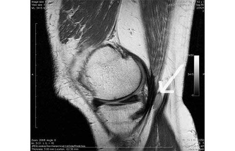 Exame de ressonância do joelho em que se observa um cisto na região posterior (seta)