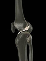 Imagem lateral do joelho com destaque para o ligamento cruzado anterior.