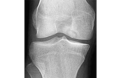 Exame radiográfico de paciente com síndrome da insuficiência do joelho.