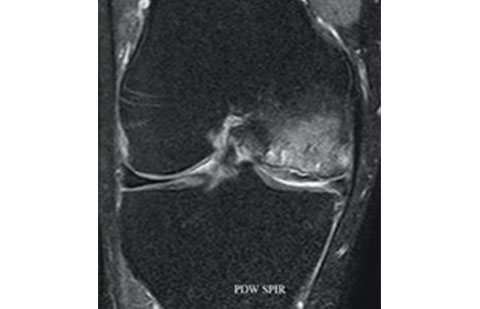 Exame de ressonância magnética de paciente com síndrome da insuficiência do joelho.