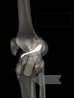 Movimento de translação anterior resistido pelo ligamento cruzado anterior.