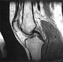Exame de ressonância magnética demonstrando o ligamento cruzado anterior íntegro