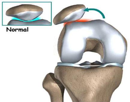 Luxação da Patela: saída da patela de sua localização normal, indo para a região lateral do joelho.