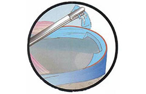 Exemplo de meniscectomia parcial por técnica artroscópica.