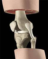 Ligamento colateral lateral