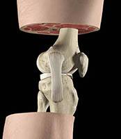 Ligamento colateral medial