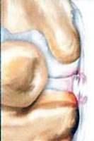 Mecanismo de Lesão do Ligamento Colateral Medial